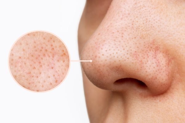 close-up-female-nose-with-blackheads-black-dots-magnifying-glass-with-enlarged-pores